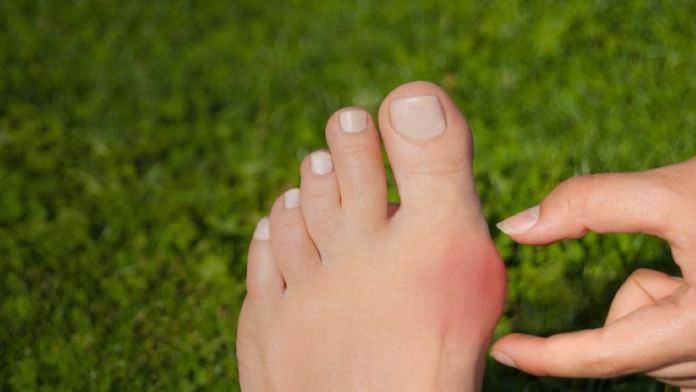 Chế độ ăn cho bệnh nhân bị gout: Nên và không nên ăn gì?